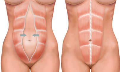 Bildene viser arrplassering ved full bukplastikk samt muskeloppstramming